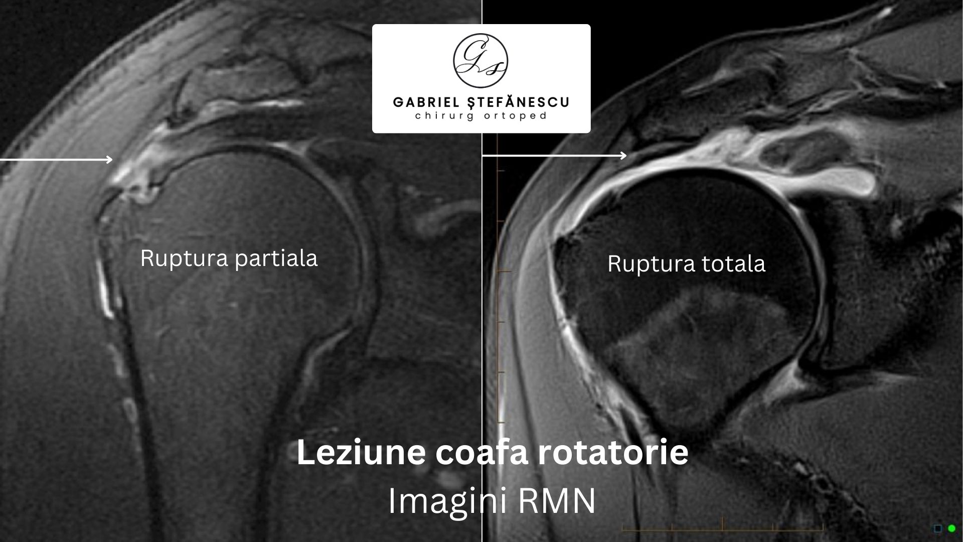 leziune-coafa-rotatorie