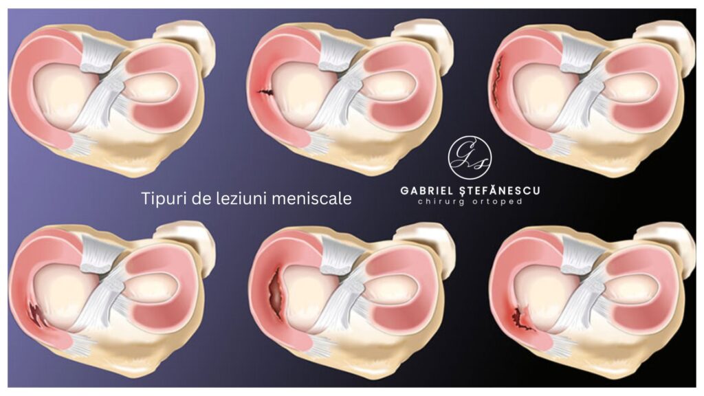 tipuri-leziuni-de-menisc DR STEFANESCU