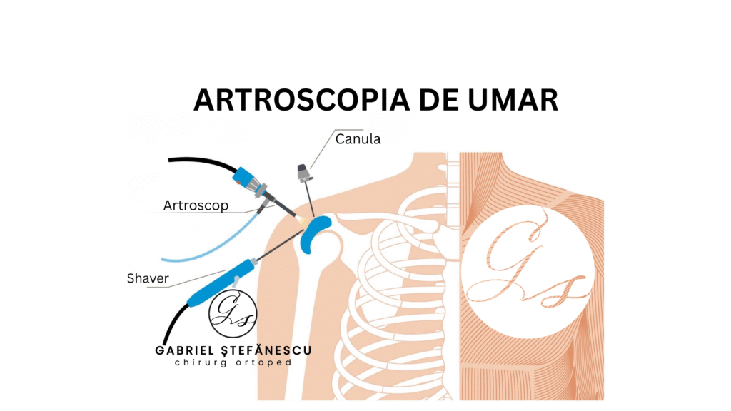 artroscopia de umar