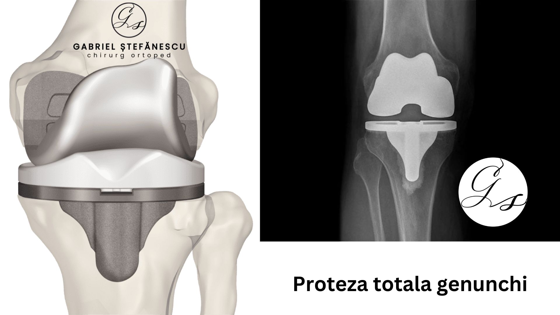 protezare-genunchi