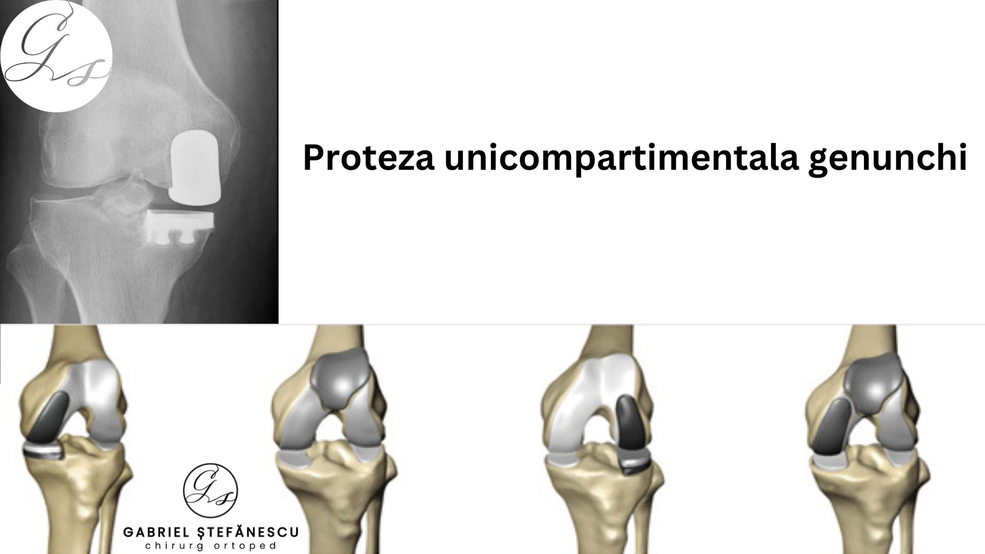 protezare-genunchi