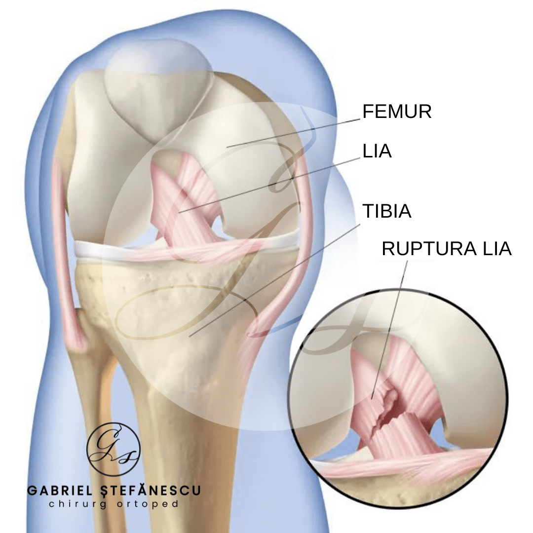 ruptura LIA