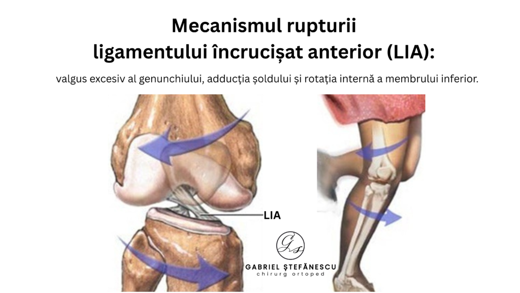 LIA DR STEFANESCU ruptură de ligament încrucișat anterior