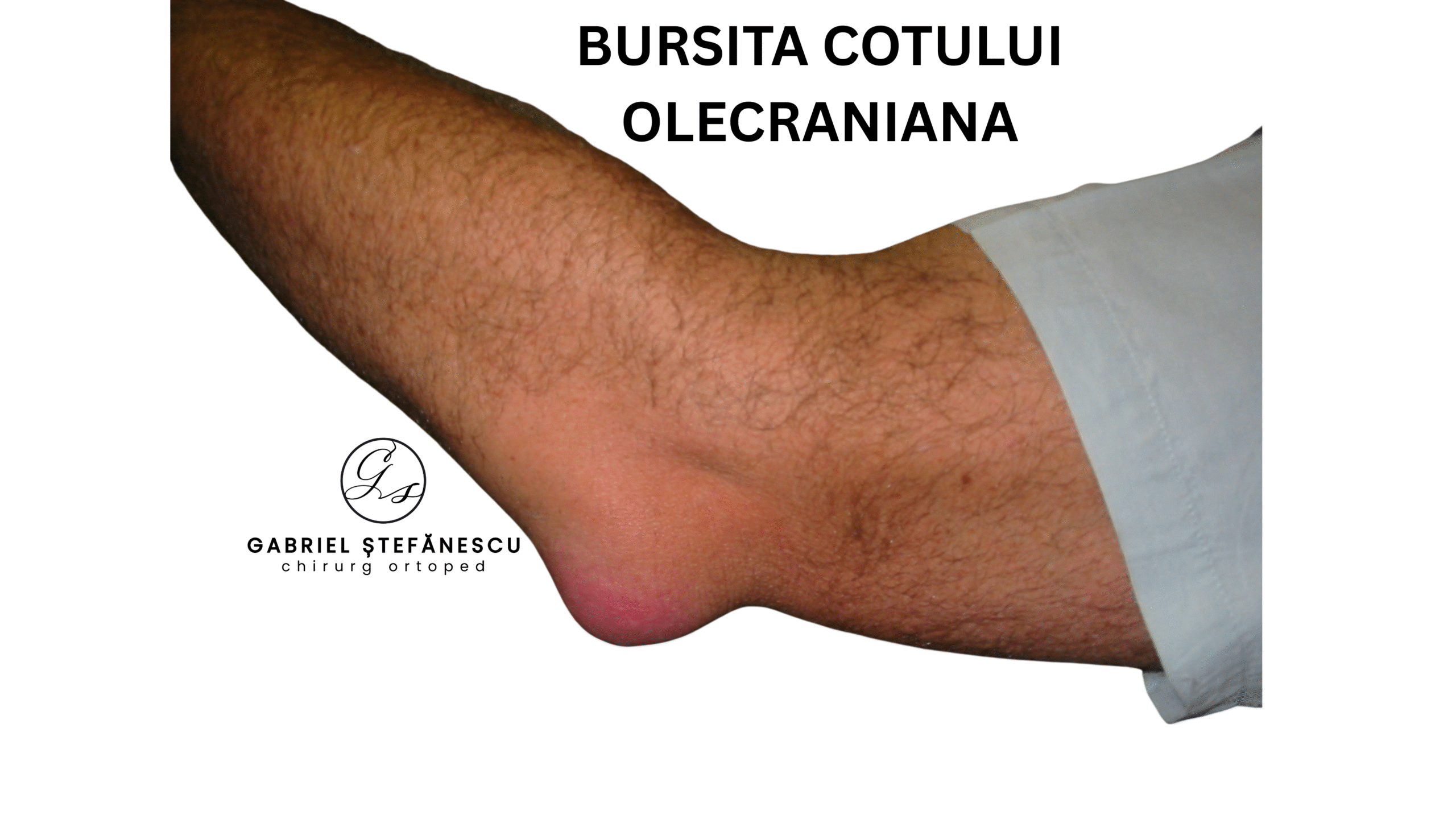 bursita-olecraniana