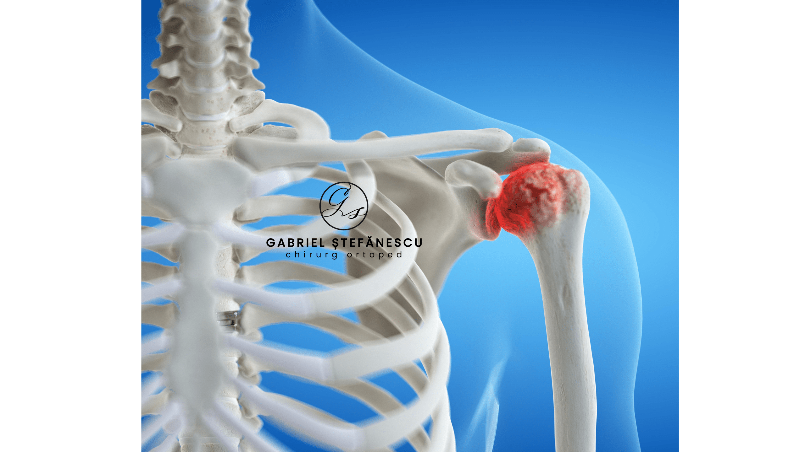 Atroza Artroza de umăr: diagnostic și tratament 0726282654 Bucuresti