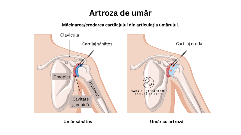 artroza de umar dr stefanescu