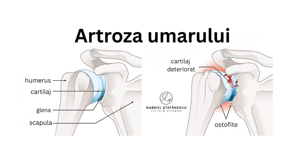 artroza umarului