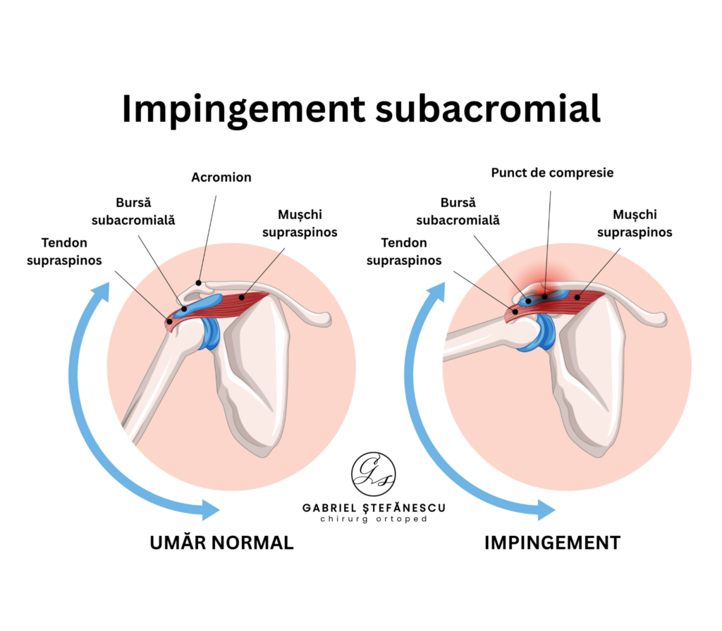 IMPINGEMENT SUBACROMIAL durere de umar