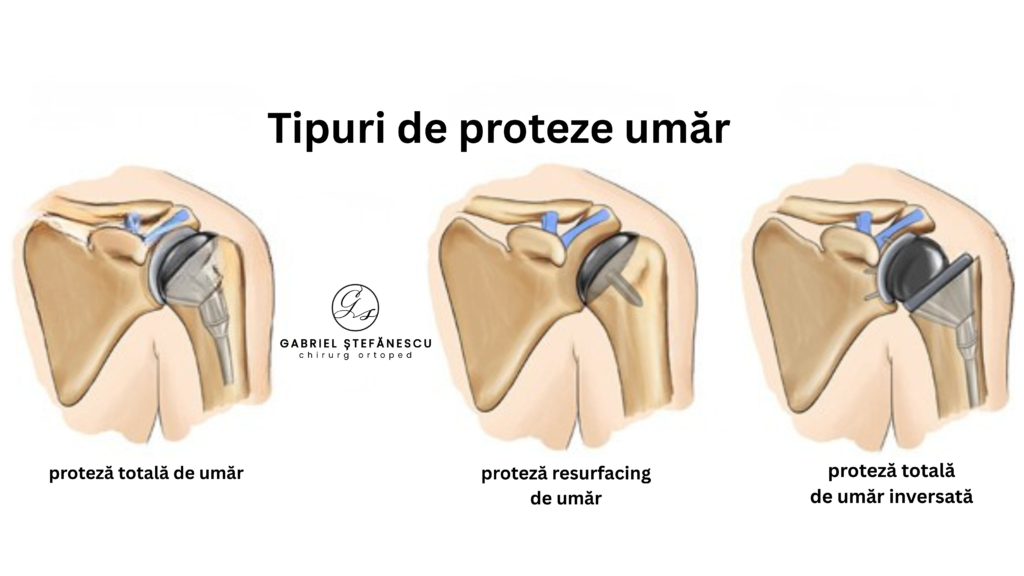 proteza umar dr stefanescu