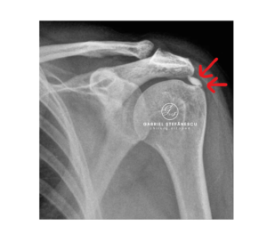 Radiografie de umar