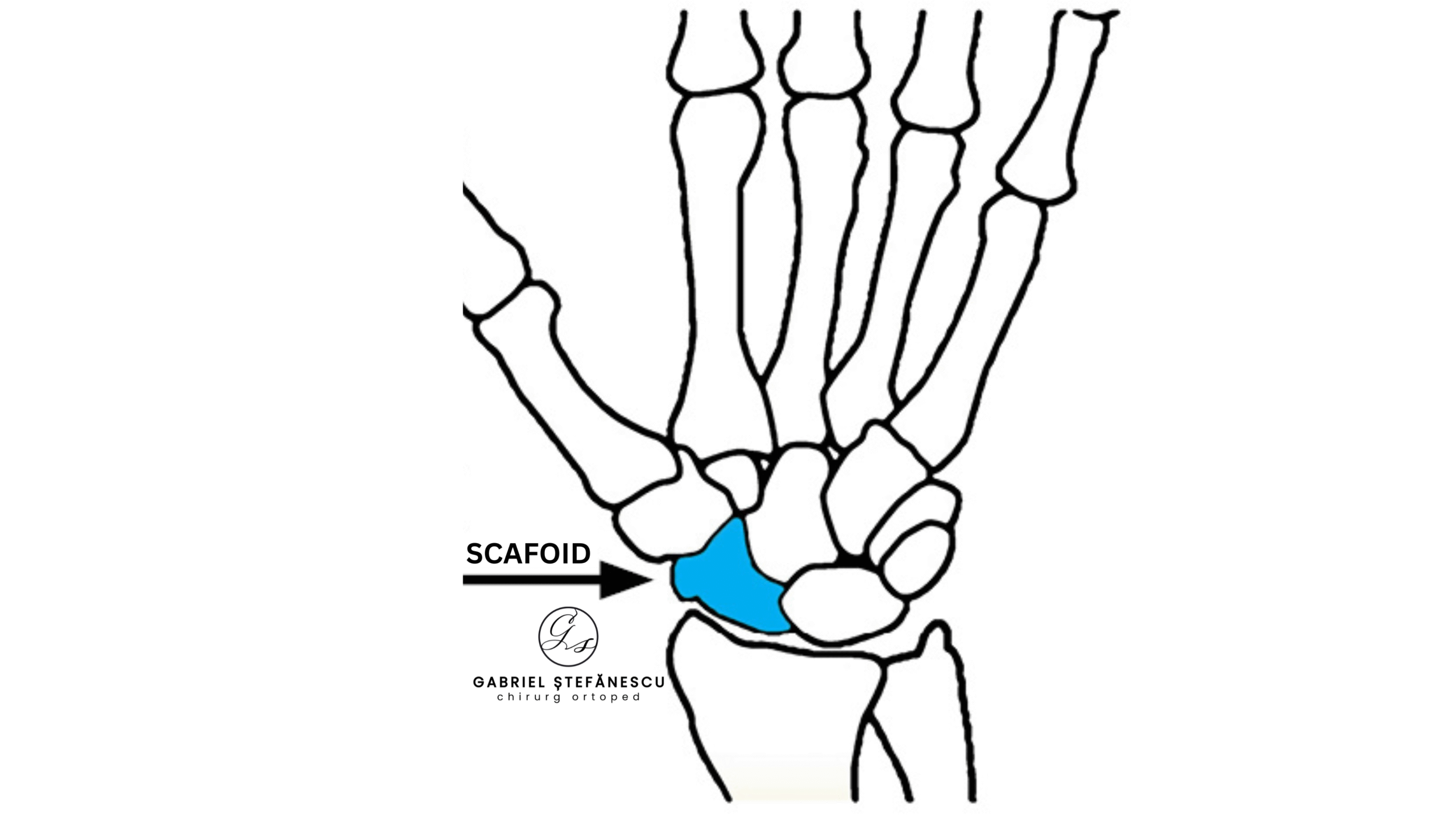 scafoid
