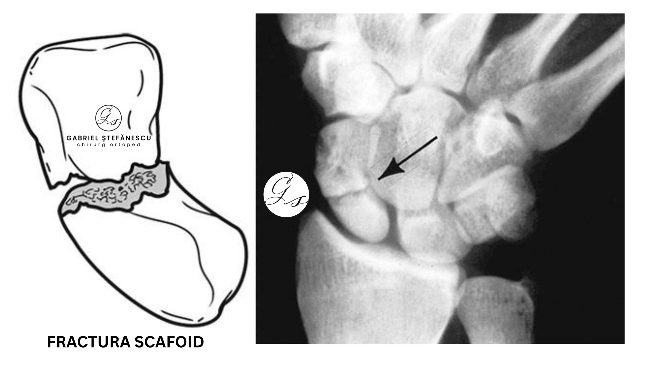 fractura-scafoid