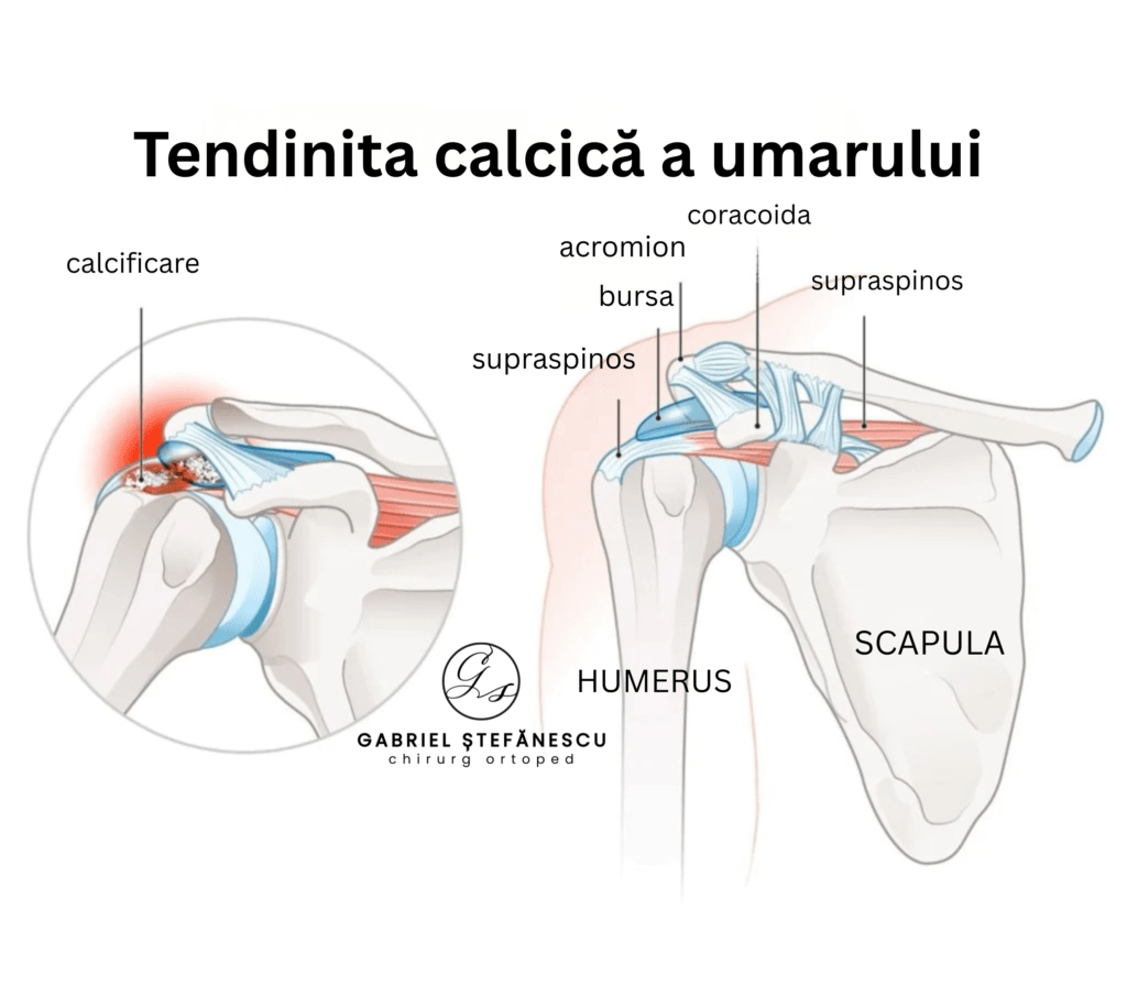 tendinita calcica a umarului