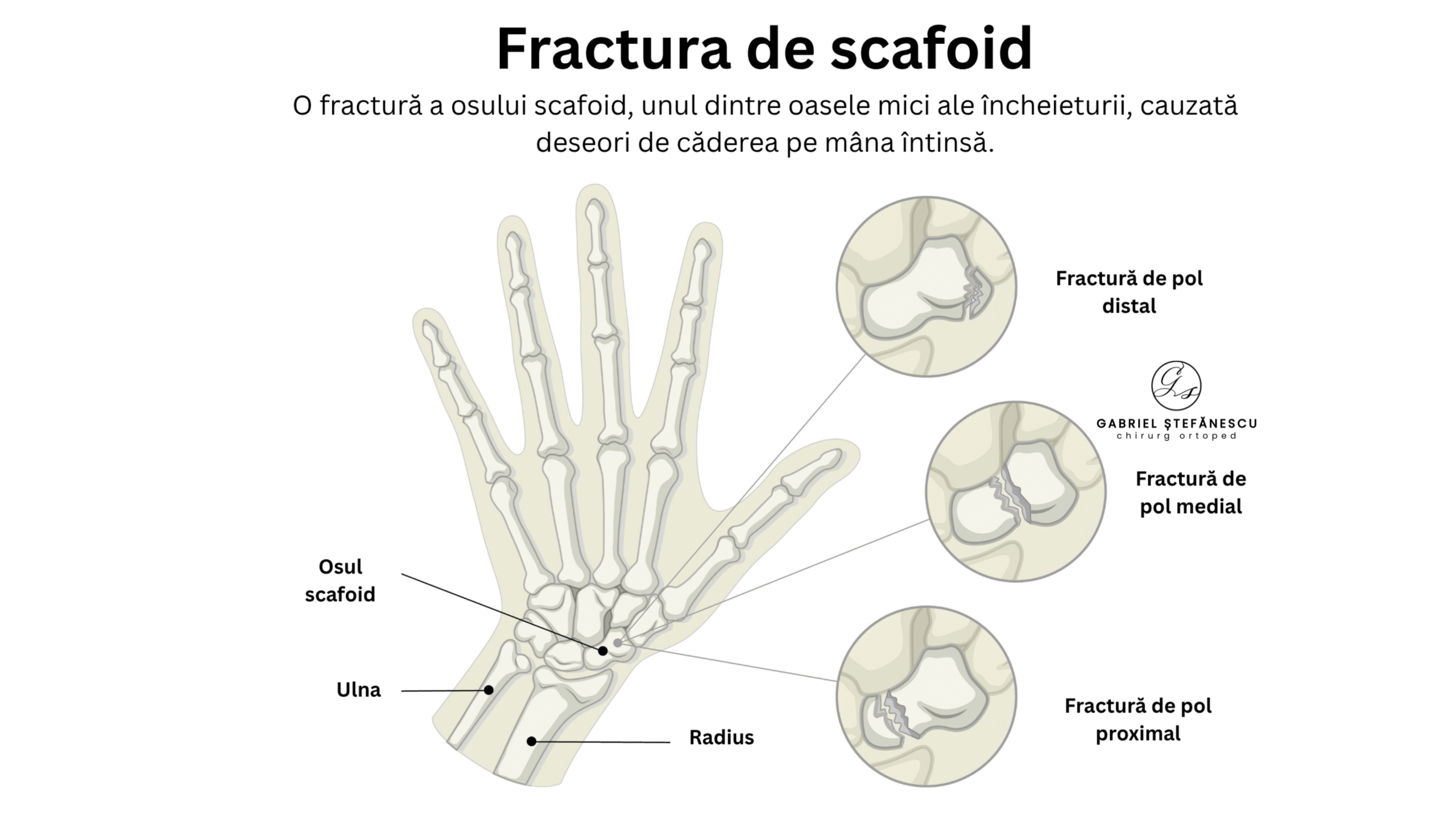 fractura-scafoid