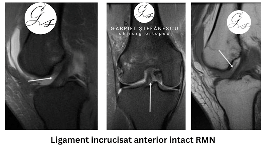 Ruptura de ligament încrucișat anterior LIA