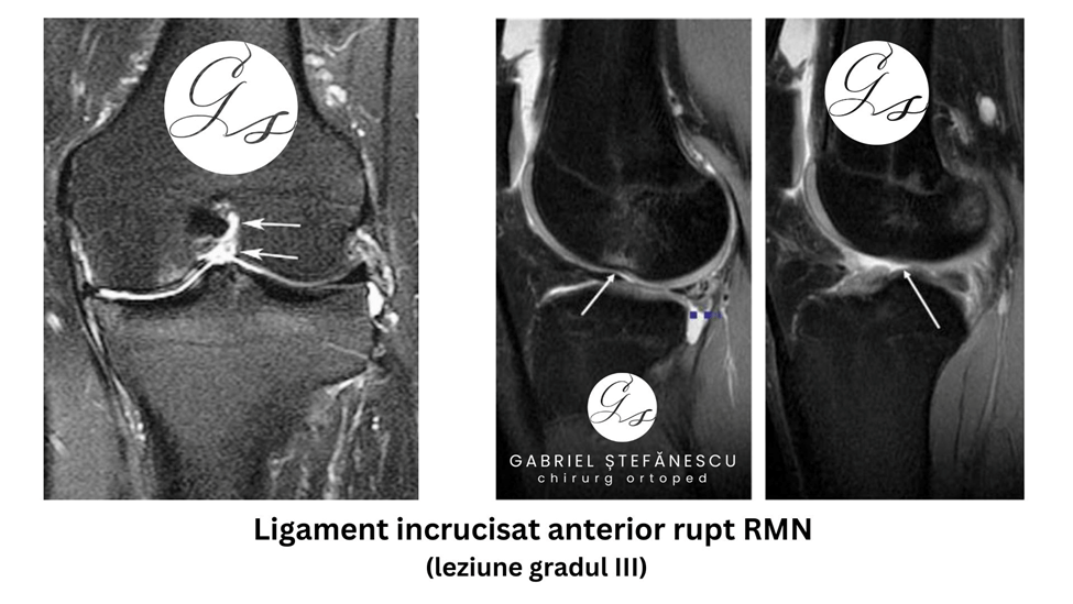 Ruptura de ligament încrucișat anterior LIA