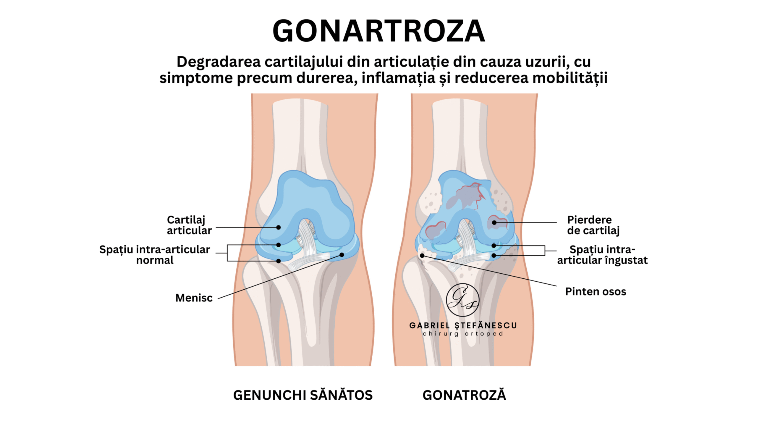 gonartroza dr. stefanescu gabriel