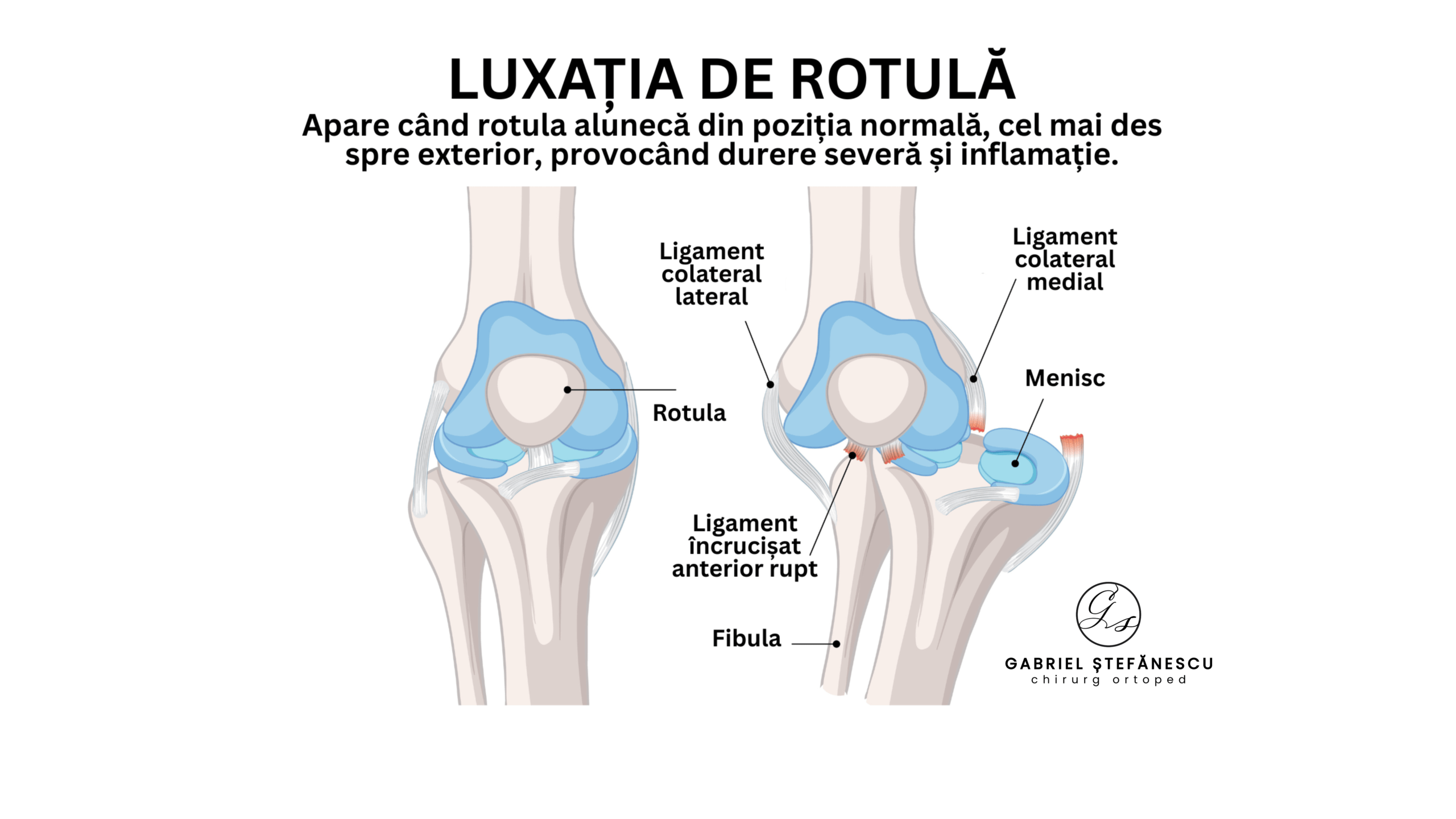 Luxatia de rotula dr stefanescu