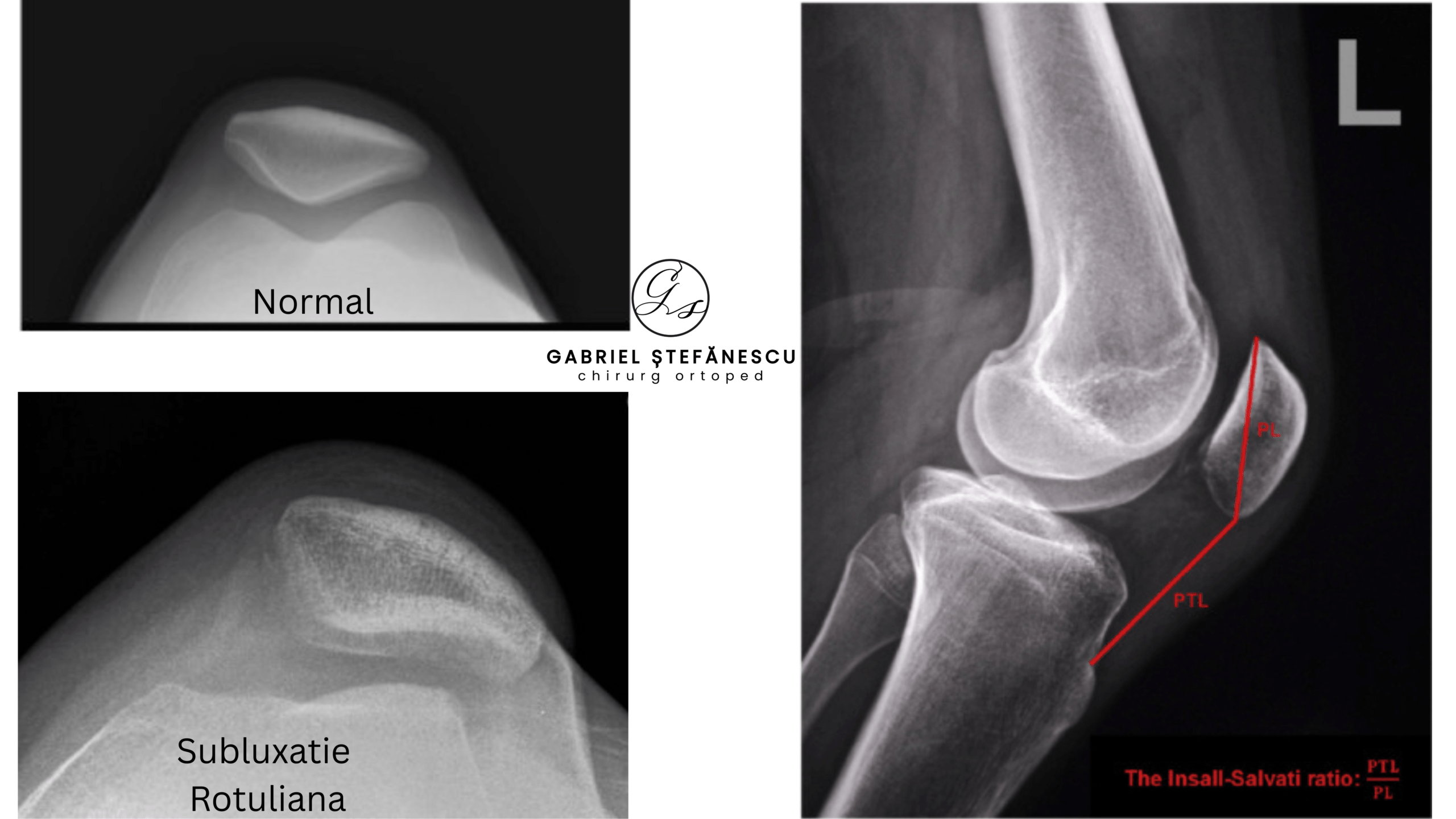 radiologie luxatie rotula dr stefanescu